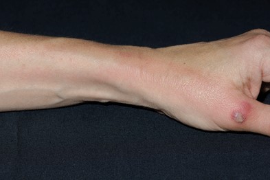 A pustule from a marine infection can be seen at the base of the thumb.
